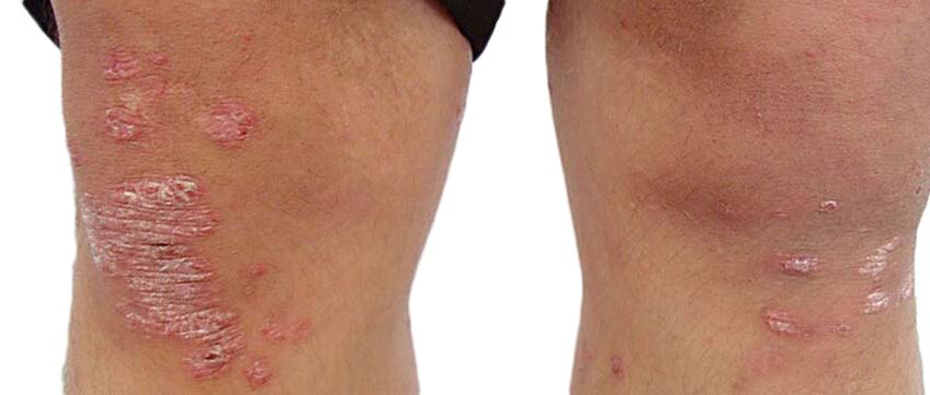 Psoriáza je nepříjemné kožní onemocnění vyžadující ošetření krémem Keraderm