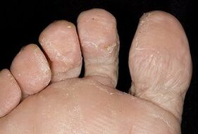 Kůže nohou s houbovou infekcí