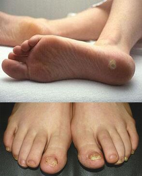 Projevy mykózy na kůži a nehtech nohou