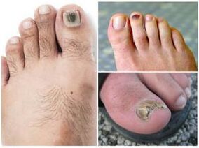 Příznaky plísňové infekce nehtů na nohou