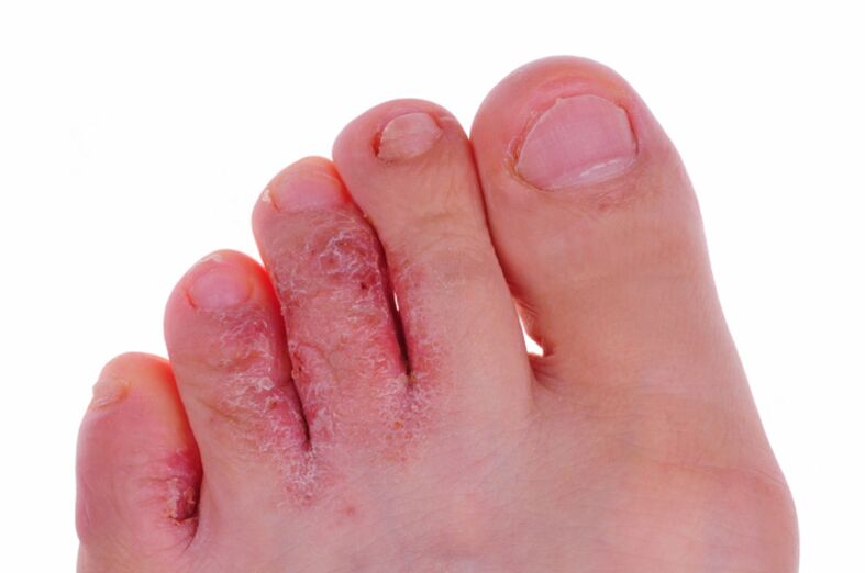 Příznaky rubrofytózy - praskliny a šupiny na kůži nohou