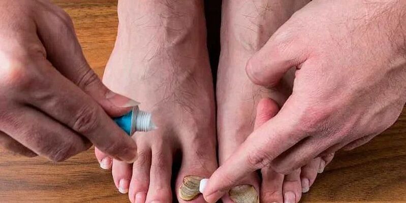 příčiny plísní mezi prsty na nohou