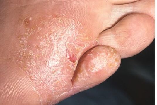 Projevy plísňové infekce na kůži nohy